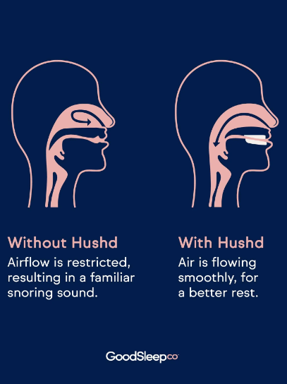 Hushd - mouthguard for snoring reduction